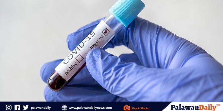 Cameraman ng ABS-CBN Manila: negatibo sa COVID-19 RT-PCR Test