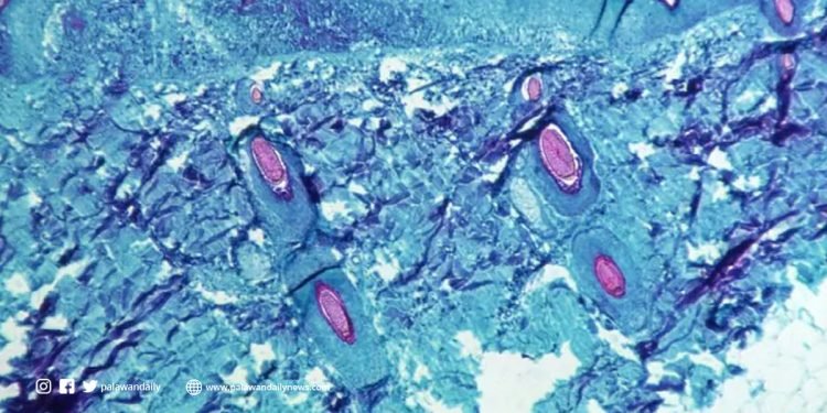 With the rising cases of ‘Monkeypox’, could this possibly be another pandemic?