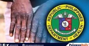 DOH: face masks not needed for mpox, no lockdown in sight
