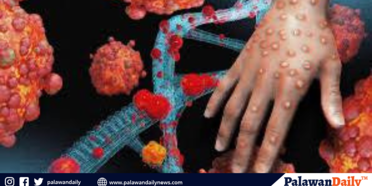 11 hiv-positive na pasyente sa davao, positibo rin sa mpox